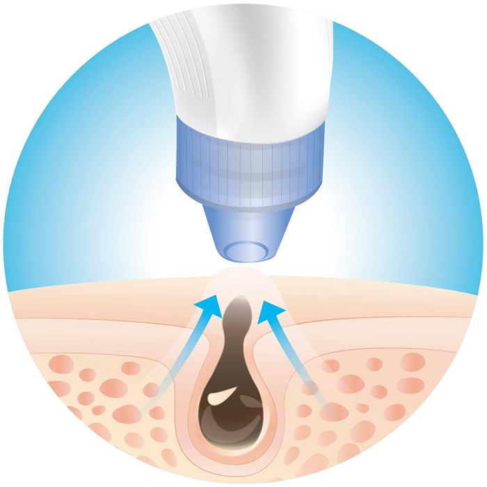 ISSAGE - SCHONER - Limpiador facial de poros <h2>Limpia los poros y reafirma la piel fácilmente con la tecnología PORE SUCTION SYSTEM de Issage</h2>

<div style=margin-left:30px;>
<ul>
<li type=disc>Incluye 4 cabezales intercambiables</li>
<li type=disc>3 velocidades para una limpieza suave y profunda</li>
<li type=disc>Diseño ergonómico, compacto y portátil para utilizar en casa o llevar de viaje</li>
<li type=disc>Batería de litio recargable incorporada</li>
<li type=disc>Carga USB</li>
</li>
</ul>
</div>


Potente extractor, succionador y limpiador de puntos negros y espinillas electrónico.

Elimina eficazmente las células muertas de la piel, las impurezas y los poros obstruidos.

Extractor de espinillas, grasa y el acné, también puede aumentar la circulación sanguínea y la elasticidad de la piel, exfoliar la piel muerta, disminuir las arrugas, reducir los poros, suavizar las líneas finas y conseguir una piel más radiante.