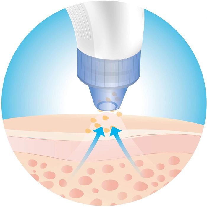 ISSAGE - SCHONER - Limpiador facial de poros <h2>Limpia los poros y reafirma la piel fácilmente con la tecnología PORE SUCTION SYSTEM de Issage</h2>

<div style=margin-left:30px;>
<ul>
<li type=disc>Incluye 4 cabezales intercambiables</li>
<li type=disc>3 velocidades para una limpieza suave y profunda</li>
<li type=disc>Diseño ergonómico, compacto y portátil para utilizar en casa o llevar de viaje</li>
<li type=disc>Batería de litio recargable incorporada</li>
<li type=disc>Carga USB</li>
</li>
</ul>
</div>


Potente extractor, succionador y limpiador de puntos negros y espinillas electrónico.

Elimina eficazmente las células muertas de la piel, las impurezas y los poros obstruidos.

Extractor de espinillas, grasa y el acné, también puede aumentar la circulación sanguínea y la elasticidad de la piel, exfoliar la piel muerta, disminuir las arrugas, reducir los poros, suavizar las líneas finas y conseguir una piel más radiante.